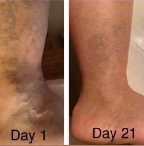 Before and after photos of bruising on ankle & foot showing appearance during collagen activation routine.