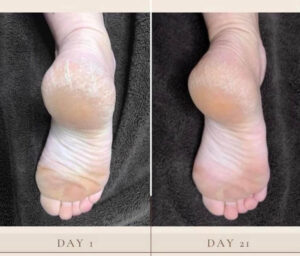Before and after photos of a woman showing cracked heel appearance during collagen activation routine.