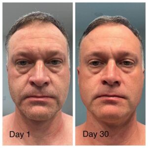 Before and after photos of a man showing visible facial appearance following collagen activation regimen.