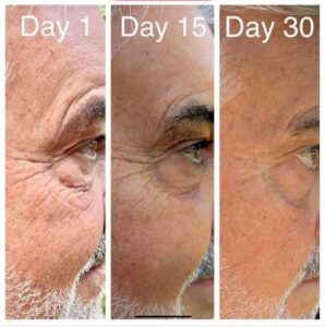 Before and after comparison of a man’s eyes during collagen activation routine.