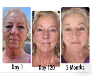 Before and after photos of a woman showing facial appearance during collagen activation routine.