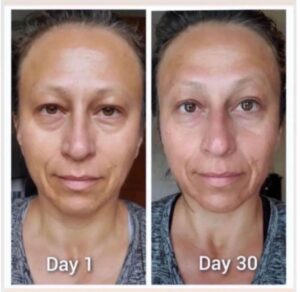 Before and after photos of a woman showing facial appearance during collagen activation routine.