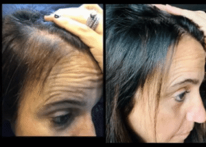 Before and after photos of a woman showing hair appearance during collagen activation routine.