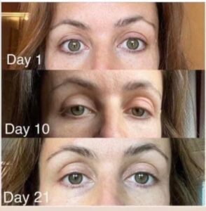 Before and after photos of a woman showing eye appearance during collagen activation routine.